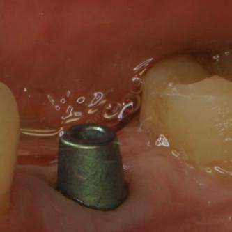 Exemple 5: Le moignon en titane est vissé sur l'implant.