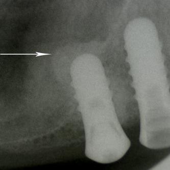 Exemple 12: Il faut donc relevé le sinus avec une greffe d'os avant de poser l'implant (Sinus lift).