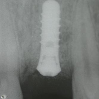 Exemple 1: L'implant remplace la racine de la dent manquante