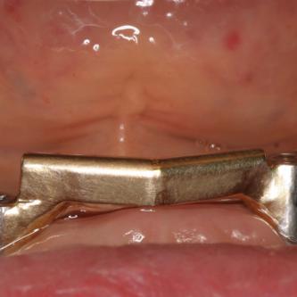 Exemple 9: Une barre est vissée sur ces 3 implants.