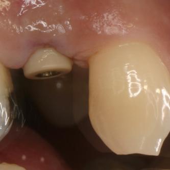 Exemple 8: Un implant au niveau de la prémolaire supérieure droite.