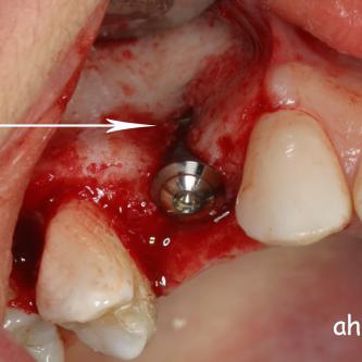 Exemple 11: Pendant l'implantation on remarque un manque d'os sur la partie externe, les spires de l'implant sont visibles.