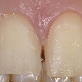Exemple 1: Ablation des anciennes résines, taille légère des dents puis empreinte.