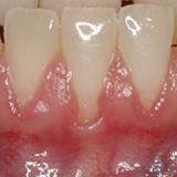 Un brossage traumatisant, l'accumulation de plaque dentaire ou de tartre peut provoquer un retrait gingival