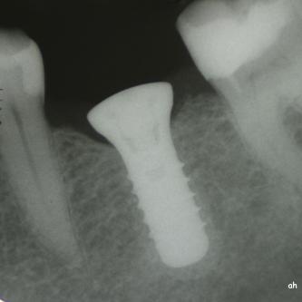 Exemple 5: Un implant au niveau d'une molaire inférieure gauche.