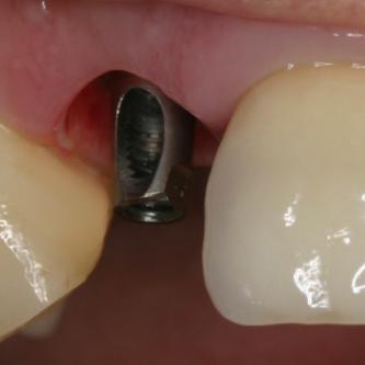 Exemple 3: Un implant à la place d'une incisive latérale supérieure droite. Sur cette image on voit le moignon en titane qui est vissé sur l'implant.