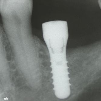Exemple 7: Un implant au niveau de la deuxième prémolaire inférieure gauche.