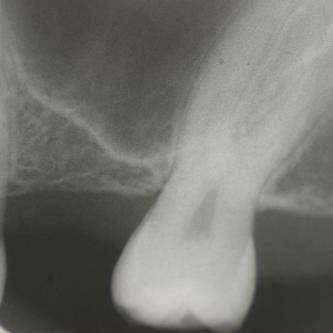 Exemple 14: Il est prévu de mettre un implant entre la molaire et prémolaire, mais le sinus se trouve à moins de 4 mm de la surface. Il faut donc relever le sinus avec une greffe d'os