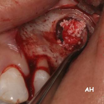 Exemple 14: La fine membrane sinusienne est relevée, puis de l'os mélangé à de l'os artificiel est introduit dans la cavité.