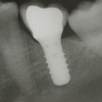 Exemple 2: Un implant remplaçant la racine d'une molaire inférieure gauche.