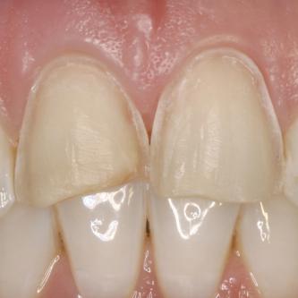 Exemple 2: Les dents sont légèrement taillées, notez les anciens traits de fractures.