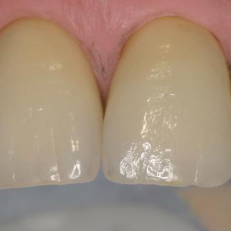 Exemple 4: Les dents ont été taillées, les traitements de racine réobturés, une empreinte suivie de la réalisation au laboratoire des couronnes en céramique.