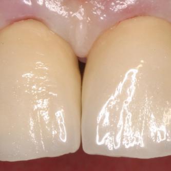 Exemple 5: Les couronnes réalisées au laboratoire sont placées sur les dents.
