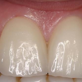 Exemple 1: Les facettes en céramique sont collées sur les dents.